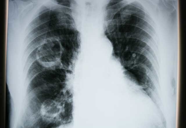 Akciğer kanseri nasıl tedavi edilir?