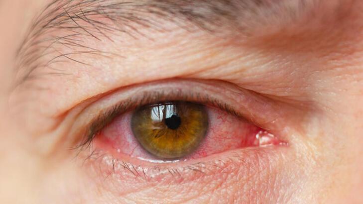 Sonbaharda görülen göz hastalıkları nelerdir?