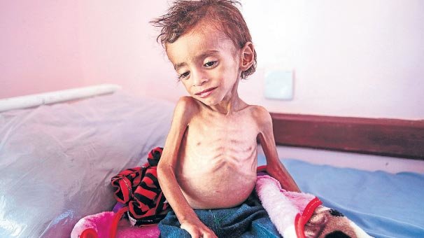 7 milyon çocuk ölümle burun buruna