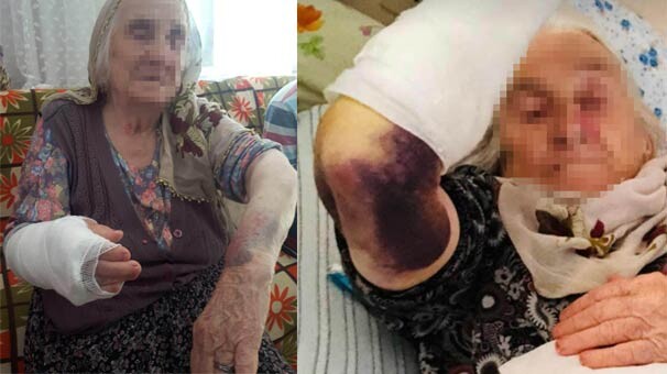 92 yaşındaki kayınvalidesini sopayla bu hale getirdi