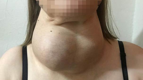 Ameliyattan korktu yıllarca böyle yaşadı