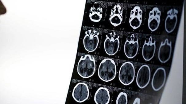 Burnu tıkalı adam nefes almak için kafasını deldi!