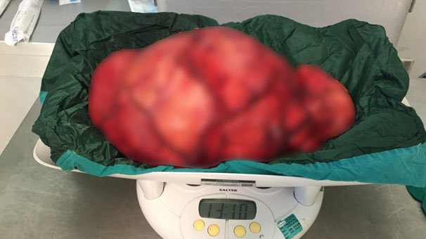 Dev tümör başarıyla çıkarıldı