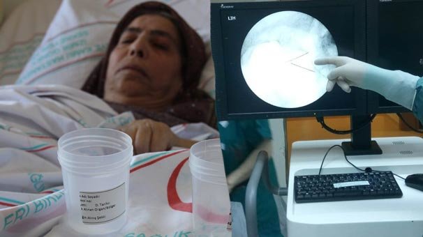 Doktorlar şoke oldu! 5 santimlik çuvaldız...