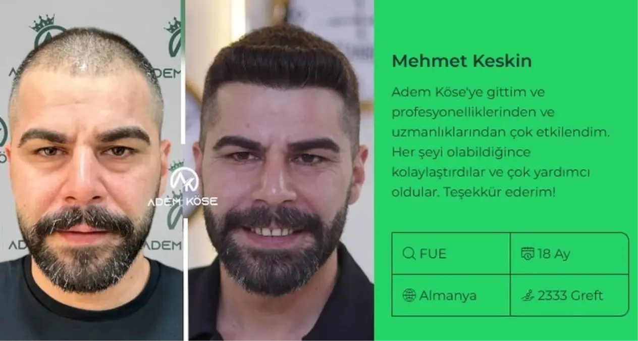 En İyi Saç Ekimi Merkezi Nasıl Seçilir? Adem Köse ile Doğal Sonuçların Peşinde