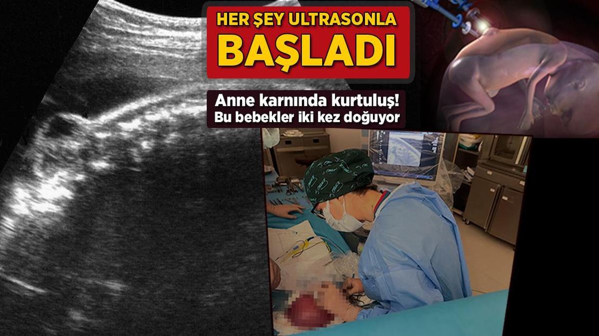 Her şey ultrasonla başladı! Anne karnında kurtuluş: Bu bebekler 2 kez doğuyor