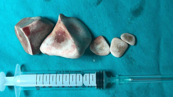 İdrar torbasından 424 gram taş çıktı
