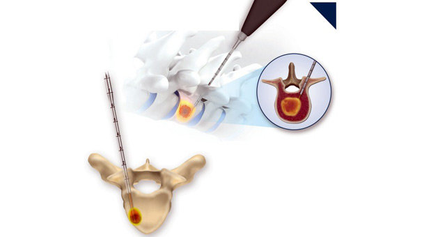 Kanser tedavisinde yeni yöntem