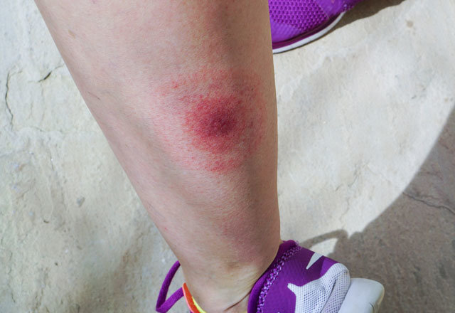 Lyme hastalığı nedir, nasıl tedavi edilir?