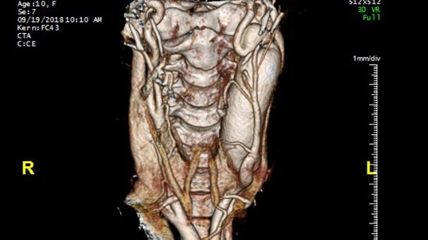 Şah damarı şişen çocuk ameliyatla sağlığına kavuştu