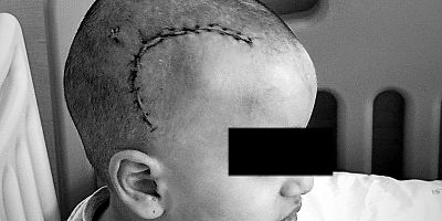 İhmaller Zincirinde Ailesinin Israrı Küçük Tomris'in Hayatını Kurtardı